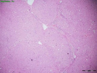 Hình 2 10 Tổn thương gan 4 6 theo Ishak BN A10 0047088 Hình 2 11 Tổn thương gan 5 6 theo 2