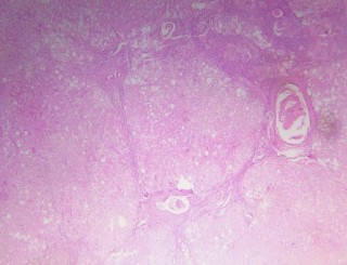 Hình 2 11 Tổn thương gan 5 6 theo Ishak BN N18 0396611 Hình 2 12 Tổn thương gan 6 6 theo 3