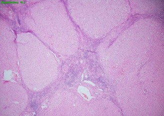 Hình 2 12 Tổn thương gan 6 6 theo Ishak BN N19 0208006 2 6 4 Thu thập số liệu Các số 4