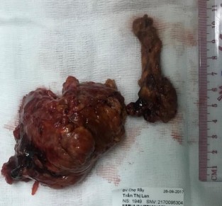Hình 3 1 Bệnh phẩm bướu sắc bào tủy TTT ác tính bên phải và chồi bướu 2