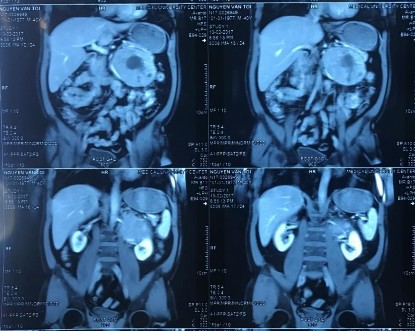 Hình 3 3 Phim CT scan bướu TTT bên trái chèn ép rốn thận trái Nguyễn Văn T 40 1