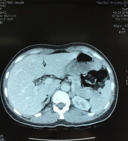 Phim CT scan bướu tuyến vỏ thượng thận bên trái Nguyễn Thị D 36 tuổi SNV 1