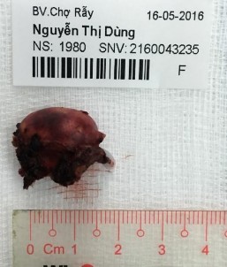 Bệnh phẩm bướu tuyến vỏ thượng thận tiết aldosterone Nguyễn Thị D 36 tuổi 2