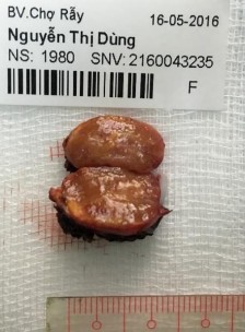 Bệnh phẩm bướu tuyến vỏ thượng thận tiết aldosterone Nguyễn Thị D 36 tuổi 3