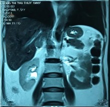 Phim MRI và bệnh phẩm bướu tuyến vỏ thượng thận bên phải BN Lương Thị Thu T 1