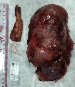 Bệnh phẩm ung thư biểu mô vỏ TTT thận trái và chồi bướu Ghi chú mô tả TM 10