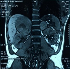 Phim MRI bướu tuyến thượng thận 2 bên Bệnh phẩm bướu sắc bào tủy TTT bên 11