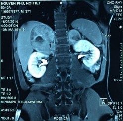 Phim MRI bướu tuyến thượng thận 2 bên Bệnh phẩm bướu sắc bào tủy TTT bên 12