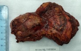 Bệnh phẩm bướu sắc bào tủy TTT bên trái Phim MRI sau phẫu thuật cắt bướu TTT 13