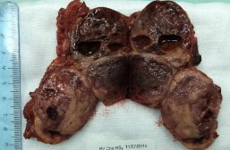 Bệnh phẩm bướu sắc bào tủy TTT bên trái Phim MRI sau phẫu thuật cắt bướu TTT 14