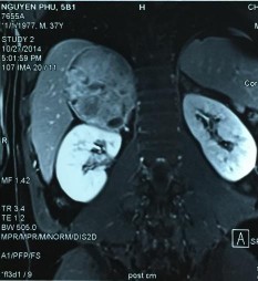 Phim MRI sau phẫu thuật cắt bướu TTT bên trái Nguyễn P 37 tuổi SNV 214061952 Phim CT 15