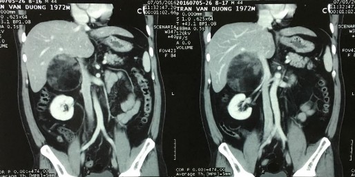 Phim CT scan bướu mỡ tủy thượng thận bên phải Trần Văn D 44 tuổi SNV 2160063310 16