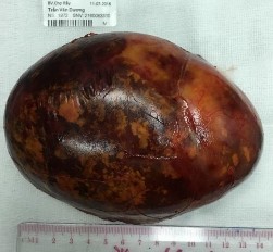 Bệnh phẩm bướu mỡ tủy thượng thận bên phải Trần Văn D 44 tuổi SNV 17