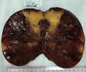 Bệnh phẩm bướu mỡ tủy thượng thận bên phải Trần Văn D 44 tuổi SNV 18