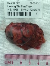 Phim MRI và bệnh phẩm bướu tuyến vỏ thượng thận bên phải BN Lương Thị Thu T 2