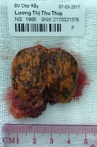 Phim MRI và bệnh phẩm bướu tuyến vỏ thượng thận bên phải BN Lương Thị Thu T 3