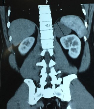 Phim CT scan bướu TTT bên trái không chức năng Hồ Đình D 32 tuổi SNV 214114642 4