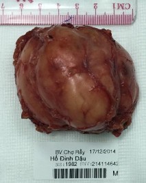 Bệnh phẩm bướu hạch thần kinh bên trái Hồ Đình D 32 tuổi SNV 214114642 Phim CT 5