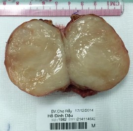 Bệnh phẩm bướu hạch thần kinh bên trái Hồ Đình D 32 tuổi SNV 214114642 Phim CT 6