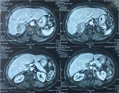 Phim CT scan bướu TTT bên phải có chồi bướu trong TM chủ dưới Trần Thị L 66 7