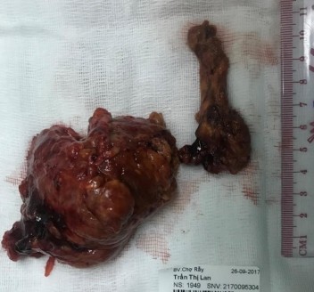 Bệnh phẩm bướu sắc bào tủy TTT ác tính bên phải và chồi bướu Trần Thị L 8