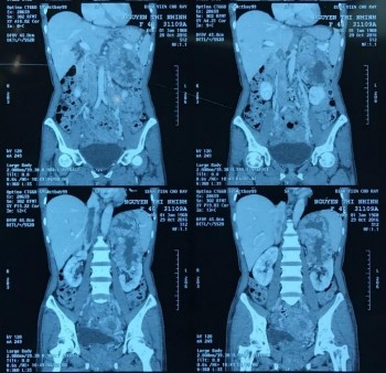 Phim CT scan bướu TTT bên trái có chồi bướu trong TM chủ dưới Nguyễn Thị N 36 9