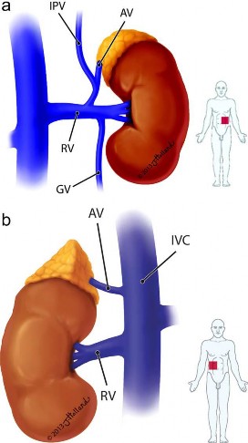 Hình 1 5 Giải phẫu tĩnh mạch tuyến thượng thận Ghi chú AV Tĩnh mạch thượng 5