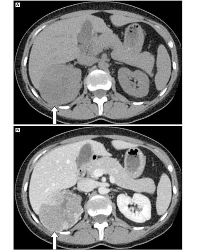 Hình 1 7 Hình ung thư vỏ tuyến thượng thận trên phim CT scan Nguồn Young W F Jr 2007 1