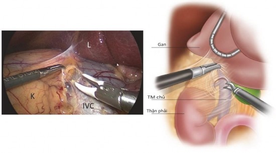 Hình 1 9 Bộc lộ TM chủ dưới nhìn trong phúc mạc Nguồn Beninato T 2019 72 3
