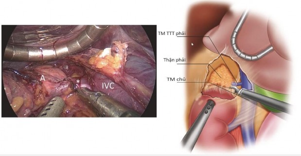 Hình 1 10 Kẹp cắt TM tuyến thượng thận phải nhìn từ trong phúc mạc Nguồn 1