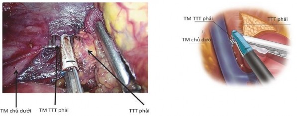 Hình 1 11 Kẹp cắt TM tuyến thượng thận phải nhìn từ sau phúc mạc Nguồn 2