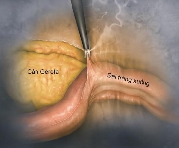 Hình 1 12 Mô tả cách tiếp cận TTT trái qua đường qua phúc mạc Nguồn Lim S K Rha 3