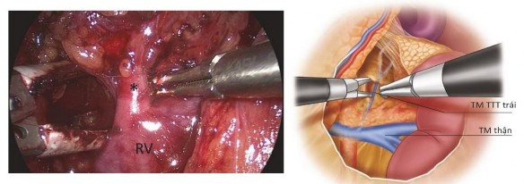 Hình 1 13 Bộc lộ TM TTT trái nhìn từ trong phúc mạc Nguồn Drake F T 2019 74 Hình 1 4