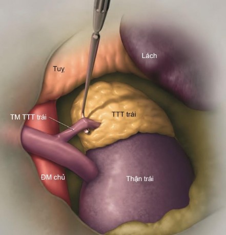 Hình 1 14 Mô tả cách bộc lộ TM TTT trái qua đường qua phúc mạc Nguồn Lim S K Rha 5
