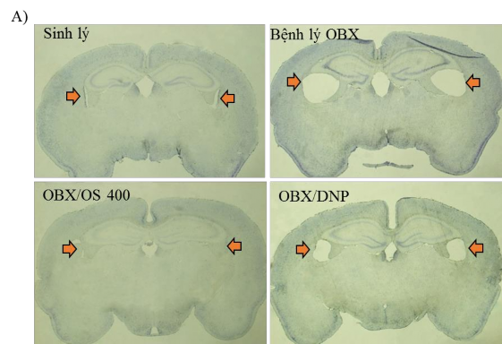 Hình 3 3 Tỷ lệ mở rộng não thất bên của các lô A Hình ảnh chụp tiêu bản 7