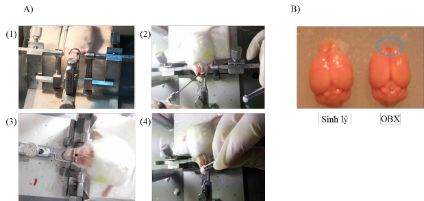 Hình 2 3 Phẫu thuật loại bỏ thùy khứu giác OBX A Hình ảnh qui trình thực hiện 1