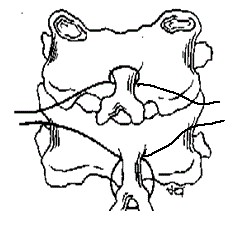 A B Hình 2 45A B Kỹ thuật xỏ chỉ của phẫu thuật Bohlman cải tiến 2 sợi chỉ 1