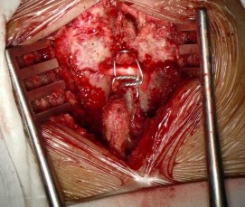 A B Hình 2 45A B Kỹ thuật xỏ chỉ của phẫu thuật Bohlman cải tiến 2 sợi chỉ 2