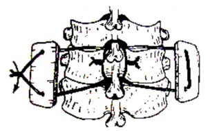 A B Hình 2 46A B Cách cố định xương ghép Dùng 1 sợi chỉ thép lần lượt xuyên 4