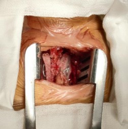 A B Hình 2 46A B Cách cố định xương ghép Dùng 1 sợi chỉ thép lần lượt xuyên 5