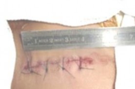 Hình 2 47 Đóng vết mổ đường mổ 5cm Nguồn từ tác giả Chăm sóc hậu phẫu và 7