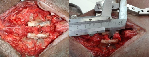 A B Hình 3 52A KHX Bohlman cải tiến đã cắt các D C phía sau Hình 3 52B Khoảng cách 3