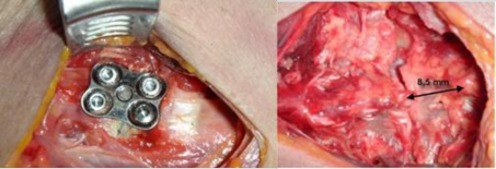 A B Hình 3 53A Nẹp –vít lối trước C4 C5 Hình 3 53B Cắt các D C phía sau khoảng 4