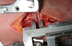 C Hình 3 53C Sau khi treo tạ 18kg khoảng cách liên mỏm gai 17 5mm 3 2 2 Kết quả thực 5