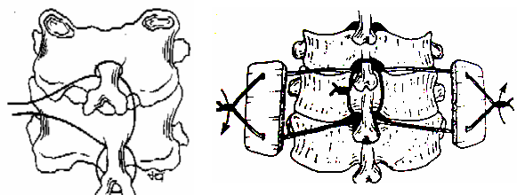 A B Hình 4 58 Phương pháp kết hợp xương Bohlman 3 sợi chỉ A Một sợi chỉ néo 1