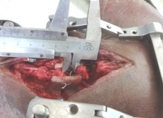 Hình 4 60 Thử nghiệm sự vững chắc của phẫu thuật Bohlman cải tiến toác rộng 2