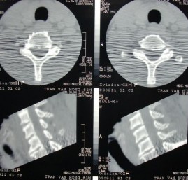 CT SCAN SAU CHẤN THƯƠNG Không thấy tổn thương ngang tầng C5 C6 bình thường 2 2