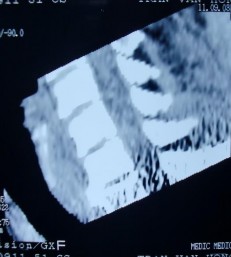 CT SCAN SAU CHẤN THƯƠNG Không thấy tổn thương ngang tầng C5 C6 bình thường 2 3