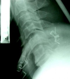 SAU MỔ C5 C6 đã được nắn chỉnh KHX Bohlman cải tiến THẲNG NGHIÊNG SAU MỔ 4 1