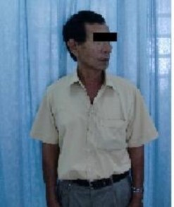 Không di lệch CÚI NGỬA Tầm vận động CSC bình thường XOAY CƠ CỔ BÌNH THƯỜNG 10